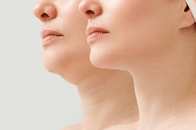 Cartessa Aesthetic fez parceria com Classys, Inc. para apresentar o Everesse