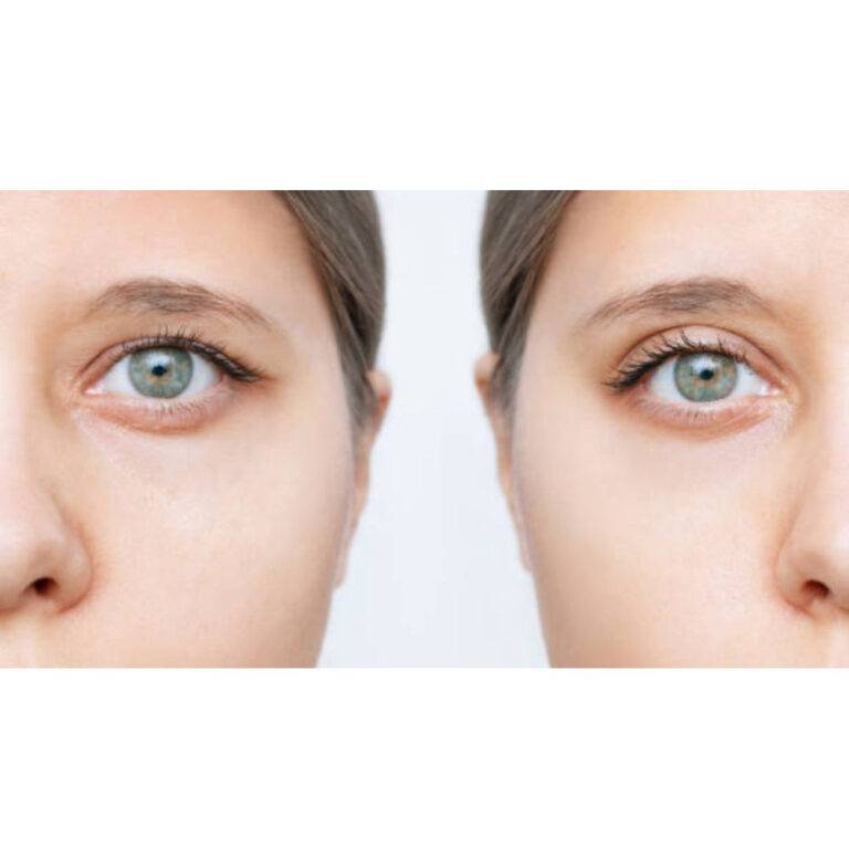 Remédios naturais para pálpebras caídas: 10 soluções fáceis em casa.