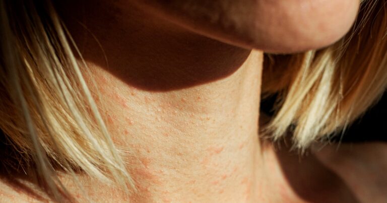 5 eczema hacks para tentar, de acordo com os médicos