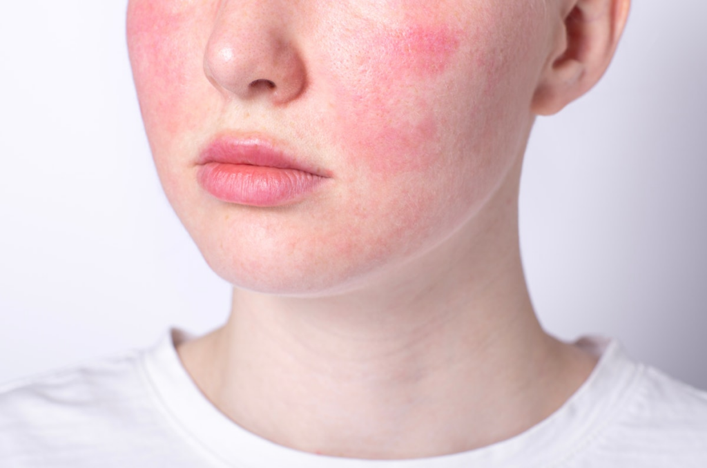 Abril é o mês da conscientização da Rosacea: Compreendendo os gatilhos, sintomas e abordagens holísticas para gerenciar essa condição de pele comum