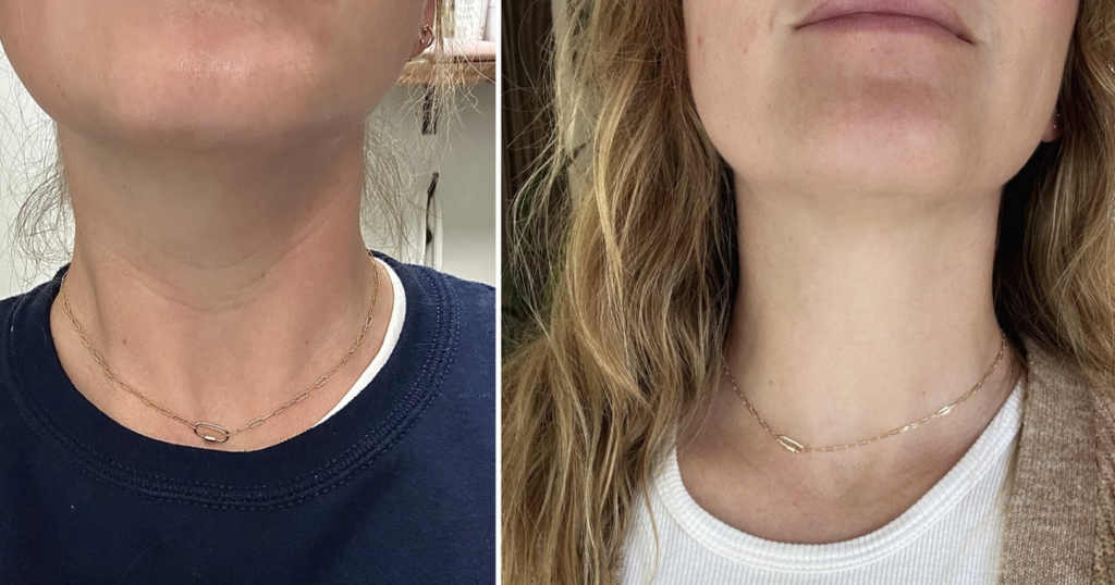 Eu tenho o pescoço botox: veja antes e depois das fotos