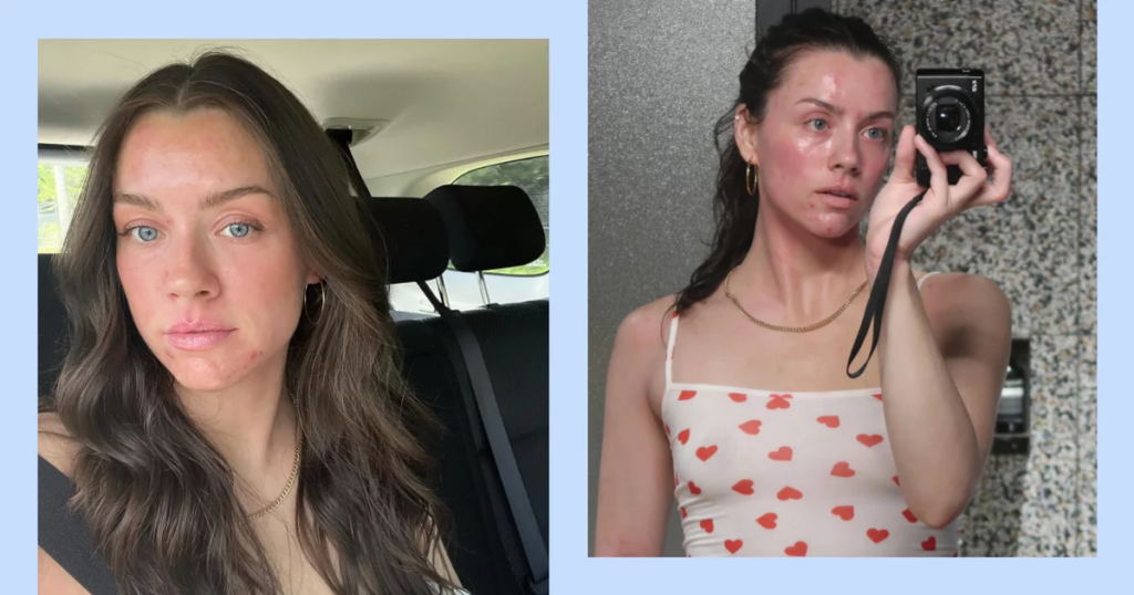 Influenciadora Madeleine Edwards sobre como entender seu eczema