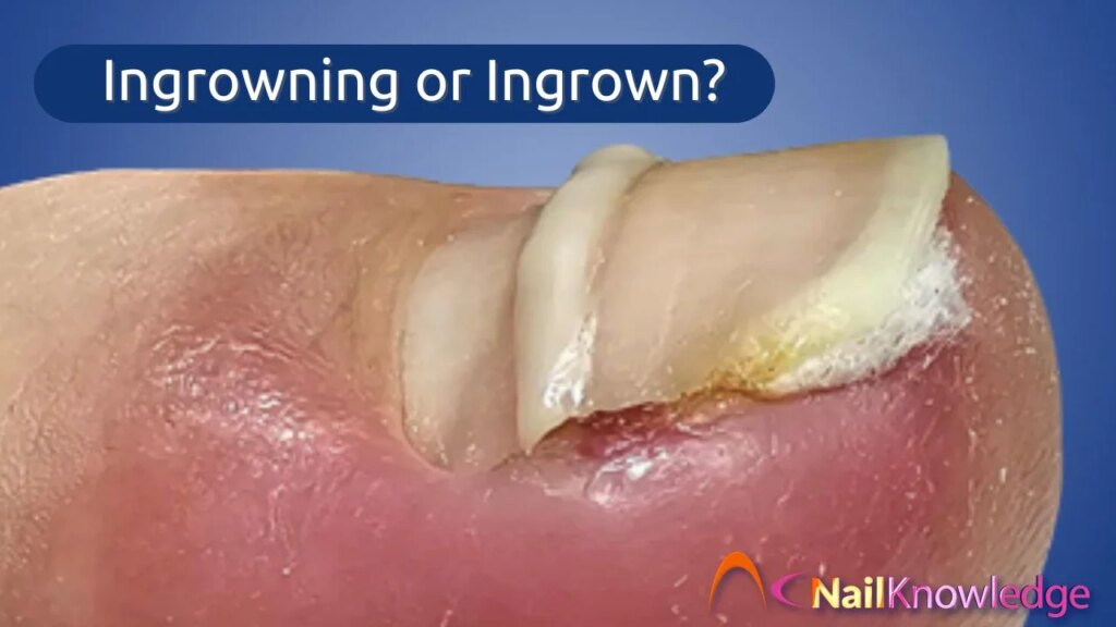Ingrowing Toe Nail - Ingrown Toenail