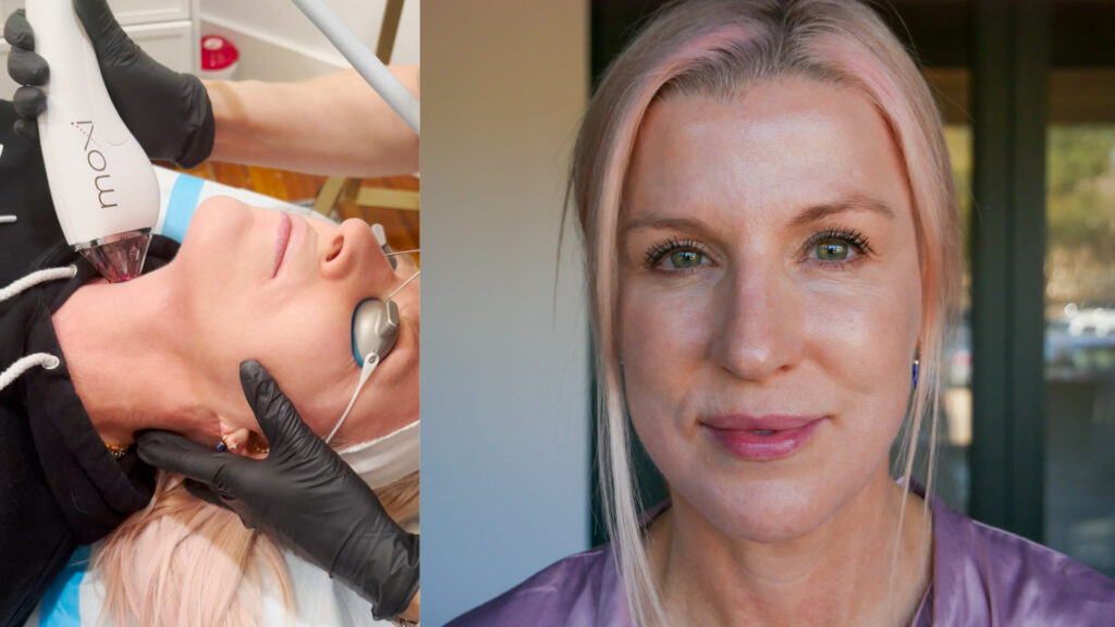 Experiência de tratamento a laser Renée Moxi: antes, depois e dicas