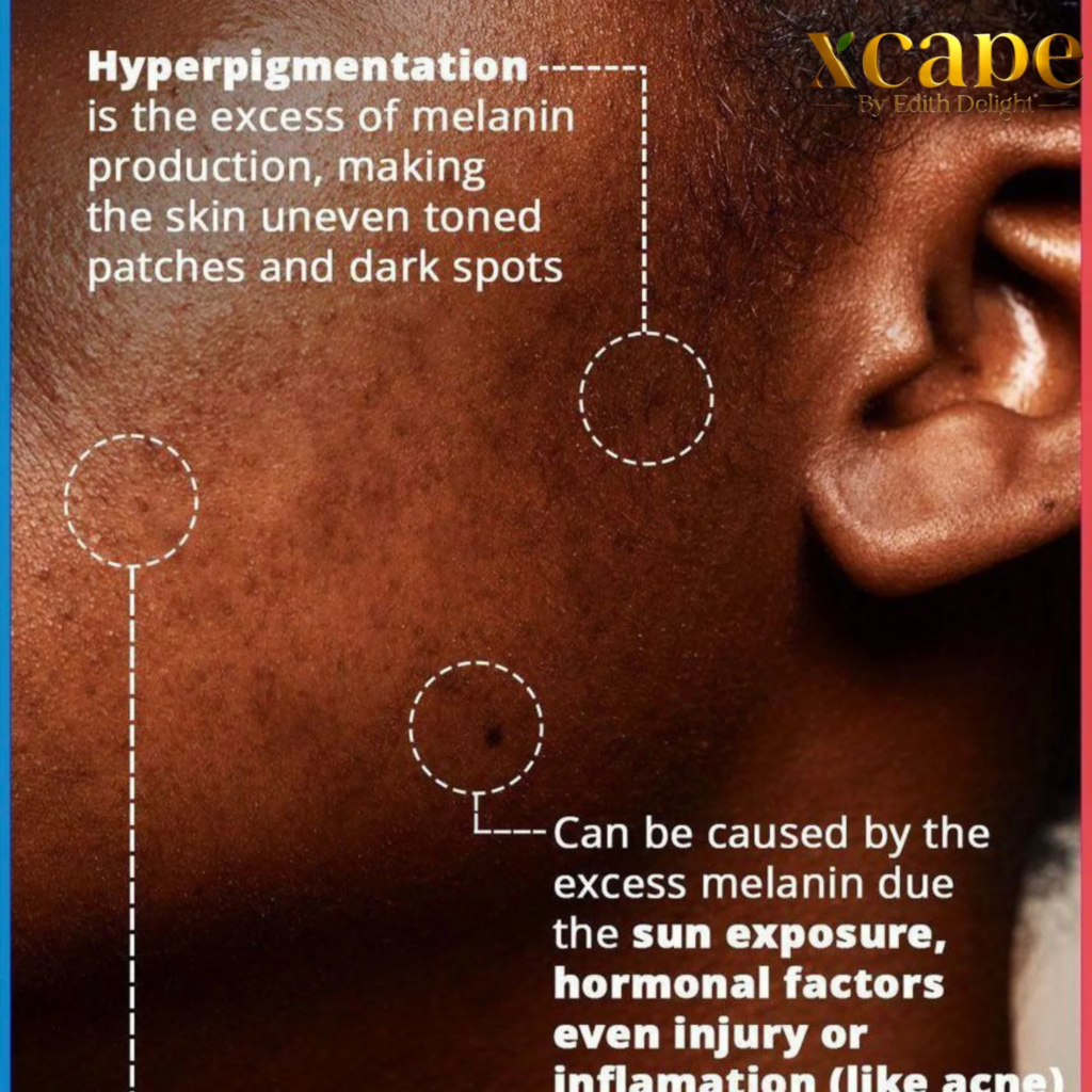 As verdadeiras causas da hiperpigmentação em pele rica em melanina e como usar o Xcap – MYXCAPE